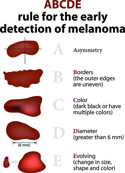 melanoma-rules for early detection