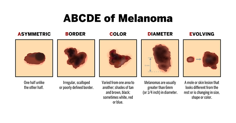 A visual representation of the ABCDE's of Melanoma